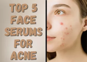 TOP 5 FACE SERUMS FOR ACNE